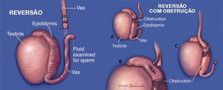 Reversão de vasectomia | Clínica de Andrologia e Urologia